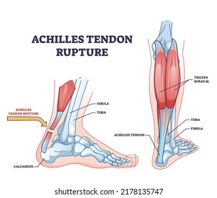 Achilles tendon rupture as painful injury and leg trauma outline diagram. Labeled educational anatomical scheme with orthopedic problem explanation vector illustration. Medical body muscle condition.