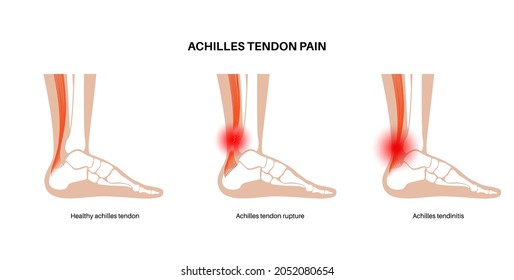 Achilles tendon rupture, tendinitis anatomical poster. Ankle injury, ligament sprain, inflammation, pain in leg and tear problems. Tendinosis and podiatry. Foot joints flat vector illustration.