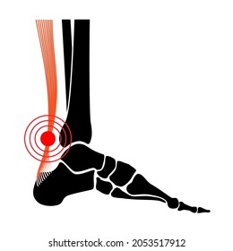 Achilles tendon rupture, tendinitis or legs inflammation anatomical poster. Ankle injury, ligament sprain, pain and tear problems. Tendinosis and podiatry. Foot joints x ray flat vector illustration.