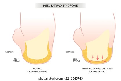 Achilles tendon tear painful and Plantar fat pad atrophy high heel ankle shoes bone spurs feet sport fascia arch of Lupus shots Steroid