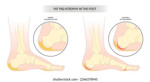 Achilles tendon tear painful and Plantar fat pad atrophy high heel ankle shoes bone spurs feet sport fascia arch of Lupus shots Steroid