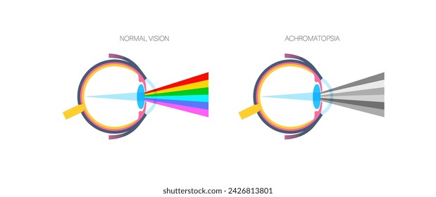 Achromatopsia and normal vision, color blindness infographic. Human vision deficiency concept. Difference between colors, brightness and intensity of shades. Eye abnormality flat vector illustration