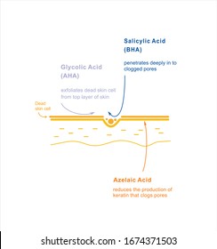Acid exposure on skin. Skin care exfoliating. Salicylic, glycolic, azelaic acid. Infographics beauty treatment. Vector illustration.