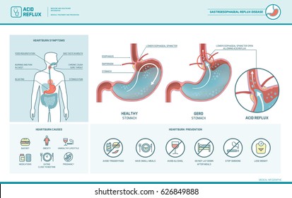 Acid Reflux, Heartburn And Gerd Infographic With Stomach Medical Illustration, Symptoms, Causes And Prevention