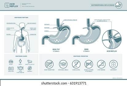 Acid Reflux, Heartburn And Gerd Infographic With Stomach Medical Illustration, Symptoms, Causes And Prevention