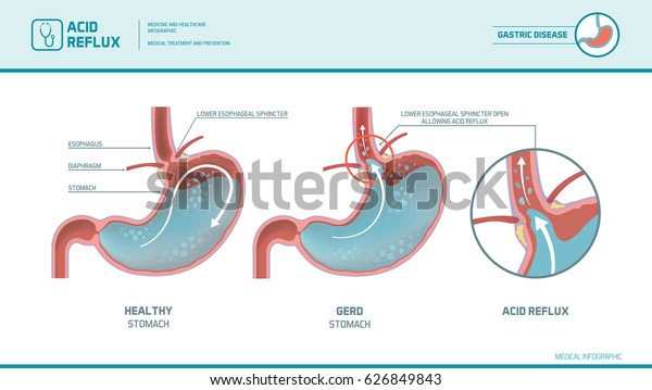 Acid reflux, heartburn and gerd infographic with\
medical illustration: stomach acid moving up into the esophagus\
causing acid reflux\
symptoms