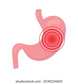 Refluxo ácido. pancreático. dor de estômago. doença gastrointestinal 