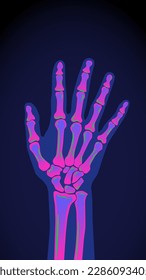 Acid X-RAY hand and wrist bones