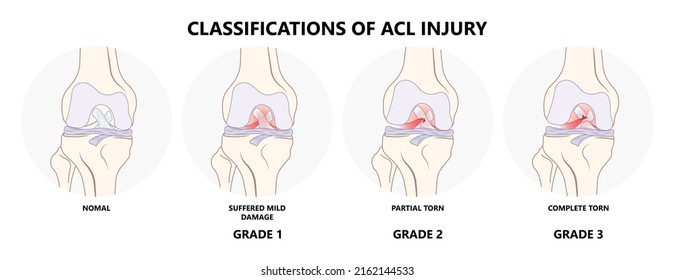 ACL Injury Knee Tear Torn Arthroscopy Bone Pain Swollen Range Of Motion Grade Thighbone Rest Ice Treat First Aid Heal