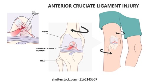 ACL Injury Knee Tear Torn Arthroscopy Bone Pain Swollen Range Of Motion Grade Thighbone Rest Ice Treat First Aid Heal