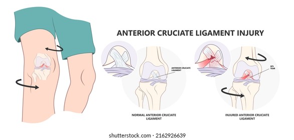 ACL injury knee tear torn Arthroscopy bone Pain swollen range of motion grade thighbone Rest Ice treat first aid heal
