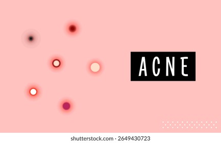 Mês da Consciência da Acne. Acne e problema de pele. Acne do tipo de pele do corpo blackheads, whiteheads, pápula, pústula, cisto e nódulos. Tipos de acne, espinhas e comedões