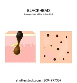 Acne. blackhead. clogged pore. Cross-section of a human skin with Hair follicle. Top view of the skin with pimples. Vector illustration. poster