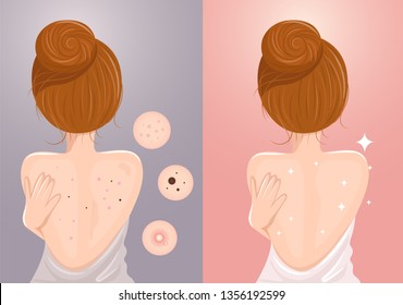 Acne caused on the back