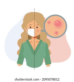 Acne caused wearing face mask.Maskne concept.pimples. Acne closeup.Flat vector cartoon character illustration.