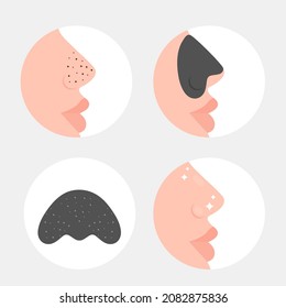 Acne cleansing nose stickers. Profile of a man with pimples on his nose. Removal of blackheads from the skin. Vector illustration, flat cartoon minimal design, eps 10.