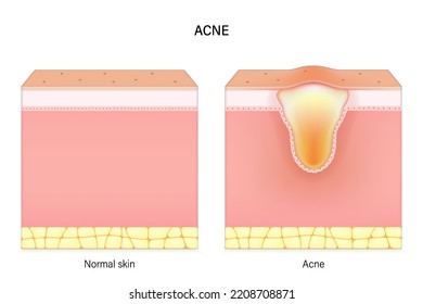 Acne. Comparison of normal skin and acne. Facial skin problems. Vector for advertising about beauty and medical treatment.