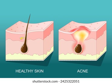 Acne. Cross section of a human skin with pimple, redness and inflammation. Vector poster. Isometric Flat illustration.