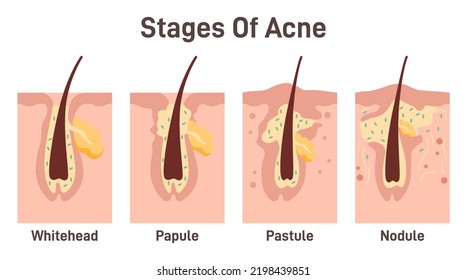 Acne development stages. Inflamed skin pimples. Plugged hair follicles, oil and dead skin cell comedo lead to bacteria grow. Flat vector illustration