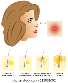 Acne. Acne is divided into four types: Comedones, Papules, Pustules, Nodules and cysts on white background.