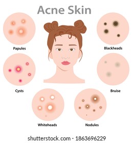 Acne face, Infographics of problem skin. Illustration skin defects