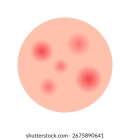 Acne facial type concept. vector illustration