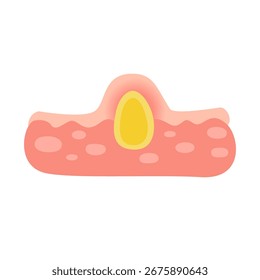 Acne facial type concept. vector illustration