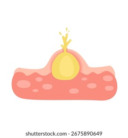 Acne facial type concept. vector illustration
