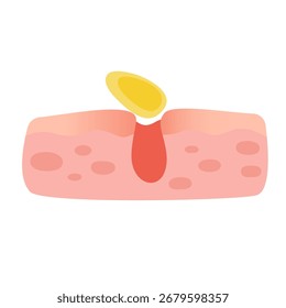 Acne facial type concept. vector illustration
