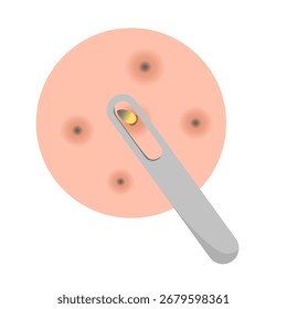 Acne facial type concept. vector illustration