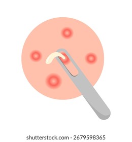 Concepto de tipo facial de acné. Ilustración vectorial