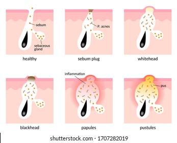 acne formation process. types of acne. Healthy skin, sebum plug, whitehead, blackhead, Papules, and Pustules.skin care concept