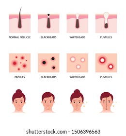 Acne Formation Types Vector Illustration Stock Vector Royalty Free Acne Formation Types Vector Illustration Stock Vector Royalty Free