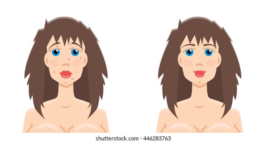 acne gir before and after