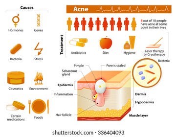 Acne. health problems. medicine in medical infographics. elements and icons for design. Skin layers