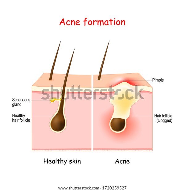 Acne Inflamed Pimple On Skin Sebum Stock Vector (Royalty Free) 1720259527