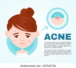 Acne infographic. Vector modern flat style cartoon character illustration. Isolated on blue background. Unhappy teen girl struggling with acne,pimples. Skin face problem concept