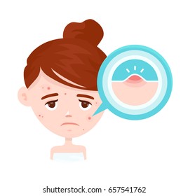 Acne infographic. Vector modern flat style cartoon character illustration. Isolated on white
background. Unhappy teen beauty girl struggling with acne,pimples. Skin face people problem concept
