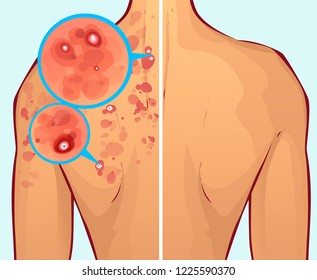 Acné en el cuerpo, antes y después. Ilustración del vector