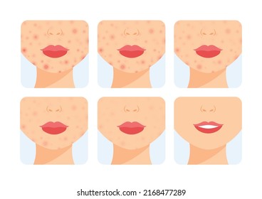 Acne on Chin and Cheeks. Female Part of Face in a Rash. Acne Treatment. Before After. Steps. Healthy Clean Skin and a Happy Smile. Color Cartoon style. White background. Vector image for Beauty design