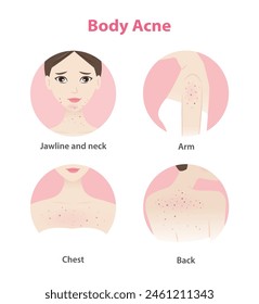 Acne on face and body woman vector icon set on white background. Pimples, blackheads, comedones, whiteheads, papule, pustule, nodule, cyst on jawline, neck, arm, chest and back. Skin problem concept.