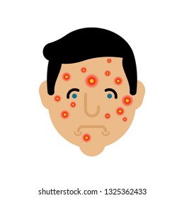 Acne on face man. Pimples on skin male
