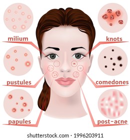 acné en la cara. Tipos de enfermedades cutáneas. Punto negro. Las glándulas no funcionan adecuadamente. Acne y acne post set. Ilustración vectorial.