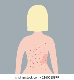 Acne on female back. Allergy treatment, skin problems concept. Caucasian short blonde hair woman on grey background in flat design. Vector illustration.