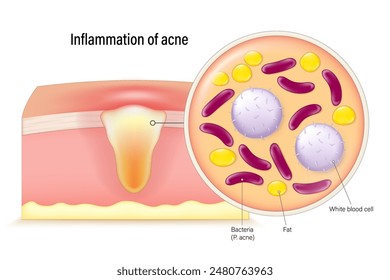 Acné en la piel y una vista ampliada de las bacterias que causan el acné. Vector para publicidad sobre tratamientos estéticos y médicos. Problemas de piel.