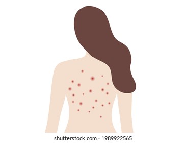 Acne On Woman Back. Allergy And Acne Skin Problems, Scratching Her Back Vector Illustration