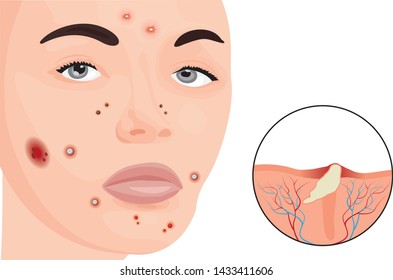 Acne on a woman face vector illustration