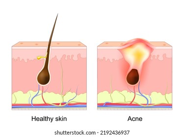 Acne pimple. normal hair follicle and clogged pore. Difference between healthy skin layer and Acne. dermatology diagram. Acne pimple patch. vector illustration