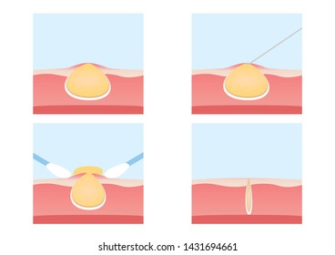 73 Removing pus vector Images, Stock Photos & Vectors | Shutterstock