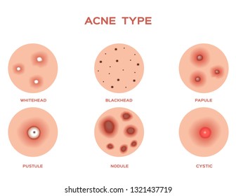 Acne and Pimples, stages of development, graphic vector